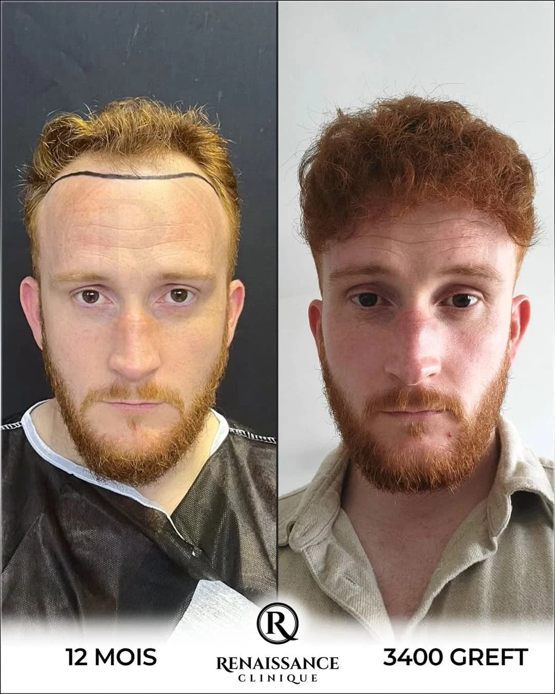 Résultat greffe de cheveux Choi Pen Istanbul - 3400 greffons - 12 mois après - Ligne frontale naturelle - Patient français - Renaissance Clinique Turquie
