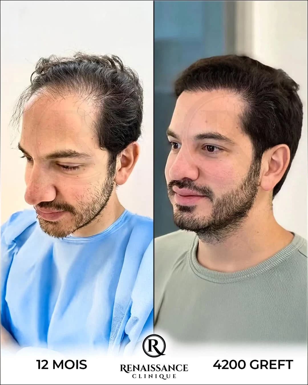 Résultat greffe de cheveux FUE Saphir Choi Pen Istanbul - 4200 greffons - 12 mois après - Patient marocain Casablanca - Renaissance Clinique Turquie