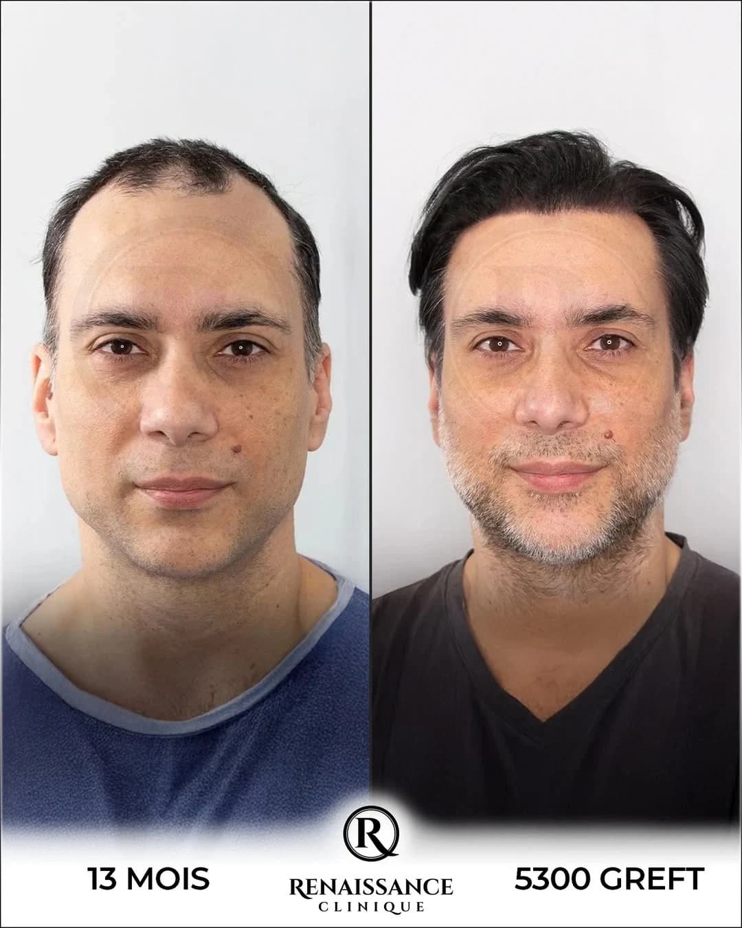 Résultat greffe de cheveux FUE Saphir Istanbul - 5300 greffons - 13 mois après - Reconstruction totale calvitie avancée - Patient suisse - Renaissance Clinique Turquie