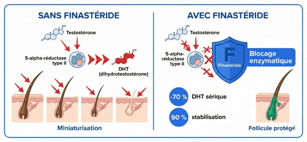 Mécanisme d'action du finastéride : blocage de la 5-alpha-réductase et protection du follicule pileux contre la DHT — Finastéride Cheveux | Renaissance Clinique Schéma comparatif du mécanisme d'action du finastéride sur le follicule pileux : à gauche (SANS FINASTÉRIDE) la testostérone est convertie par la 5-alpha-réductase de type II en DHT (dihydrotestostérone), les flèches rouges montrent la DHT attaquant le follicule pileux qui se miniaturise progressivement en 4 stades jusqu'à l'atrophie complète ; à droite (AVEC FINASTÉRIDE) le bouclier bleu Finastéride bloque l'enzyme 5-alpha-réductase (blocage enzymatique), empêchant la production de DHT, résultat : −70 % de DHT sérique, 90 % de stabilisation, follicule protégé avec cheveu terminal épais en phase anagène