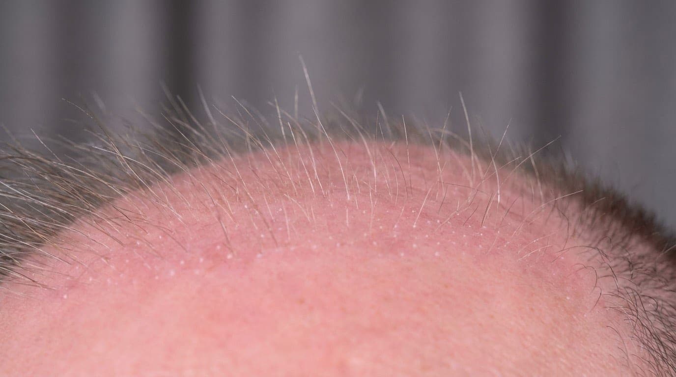 Shock Loss Après Greffe de Cheveux — La Repousse Commence à M3 | Renaissance Clinique Cuir chevelu sain à M3 après shock loss montrant de fins nouveaux cheveux émergents en gros plan macro — le bulbe est resté vivant et la repousse commence