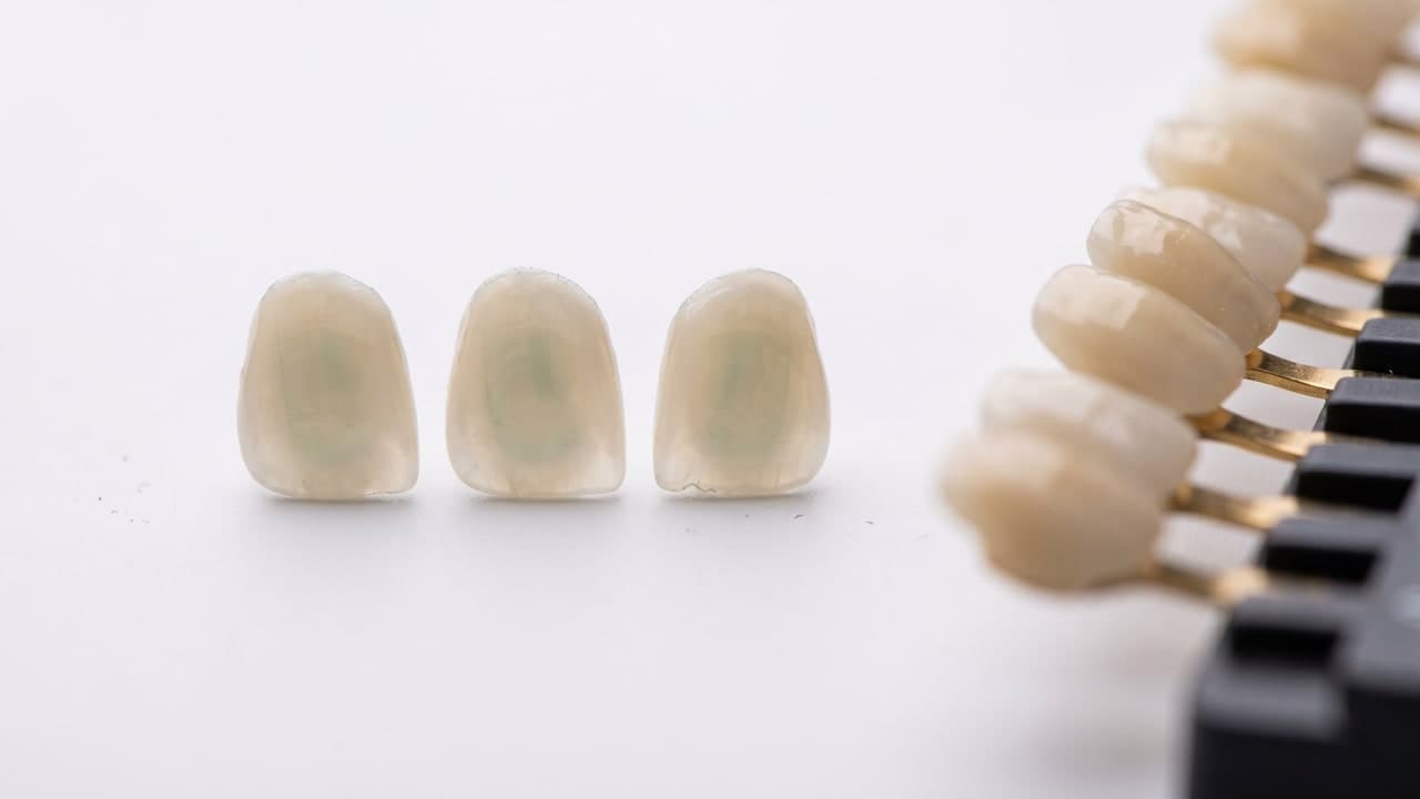 Facettes E.max ultrafines translucides en disilicate de lithium — Renaissance Clinique Istanbul