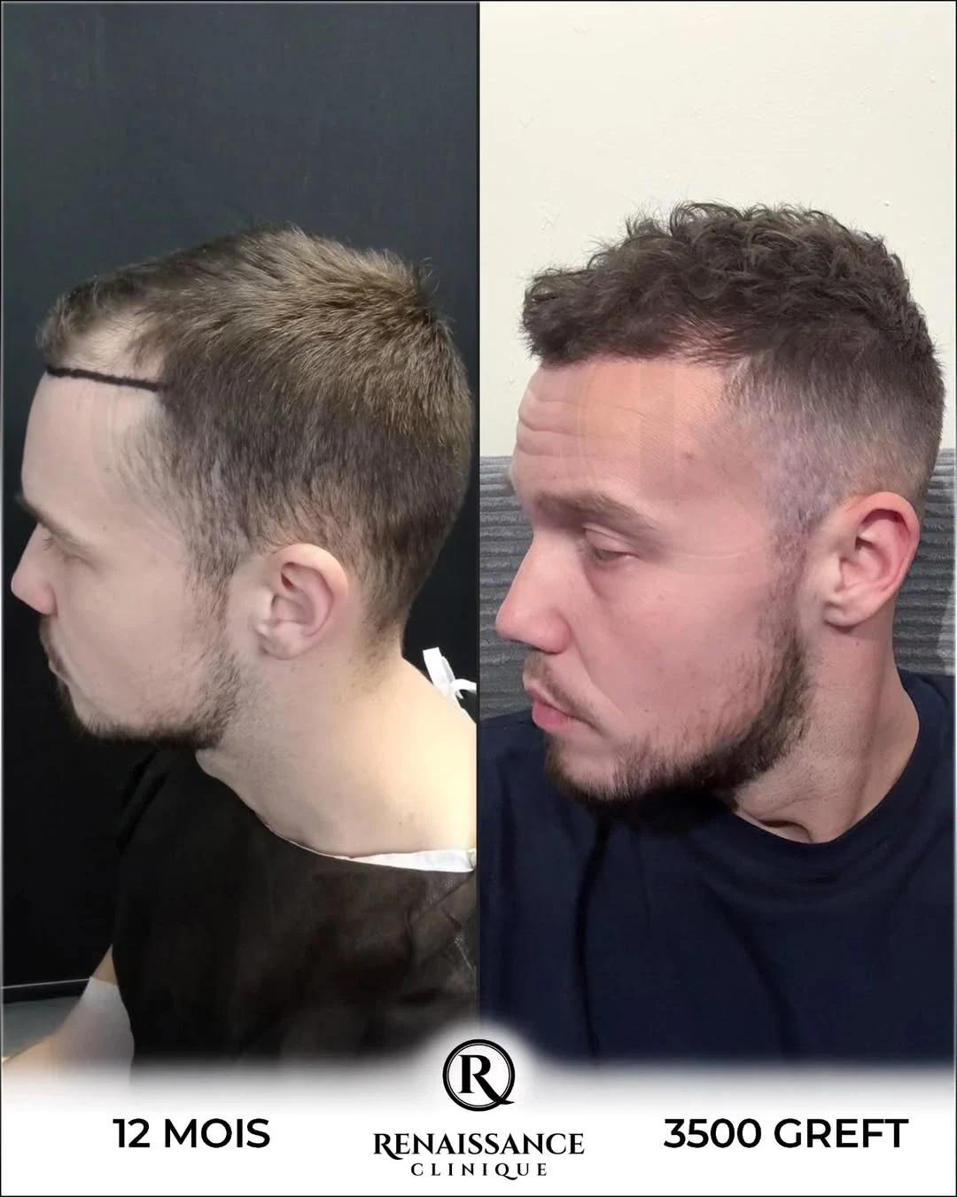 Résultat greffe de cheveux FUE Saphir Istanbul - 3500 greffons - 12 mois après - Patient belge Bruxelles - Renaissance Clinique Turquie