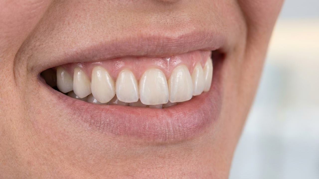 Résultat clinique d'une réhabilitation maxillaire complète All-on-4 en zircone monolithique à Renaissance Clinique