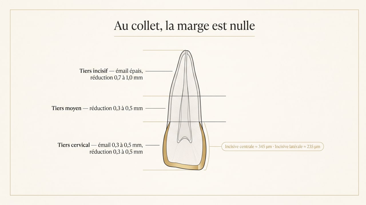 Coupe schématique d'une incisive montrant l'épaisseur d'émail disponible au tiers cervical comparée à la réduction nécessaire pour une facette dentaire