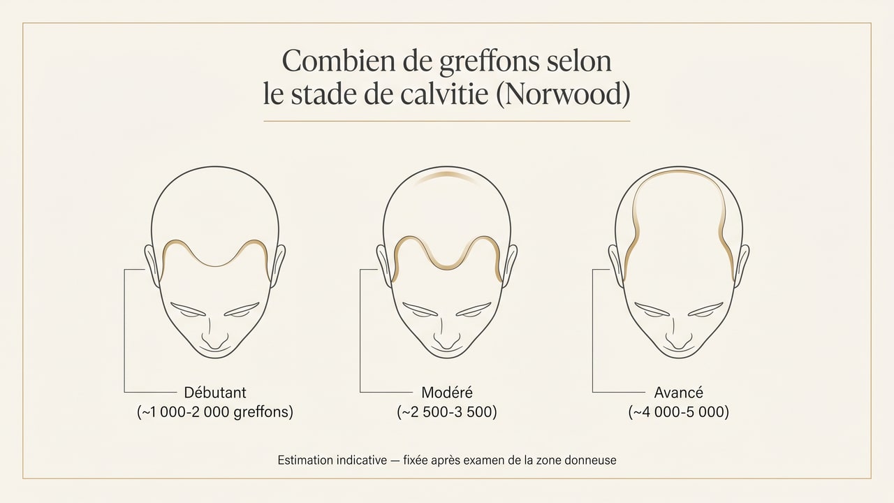 Schéma du nombre de greffons nécessaires selon le stade de calvitie de Norwood : débutant 1 000-2 000, modéré 2 500-3 500, avancé 4 000-5 000