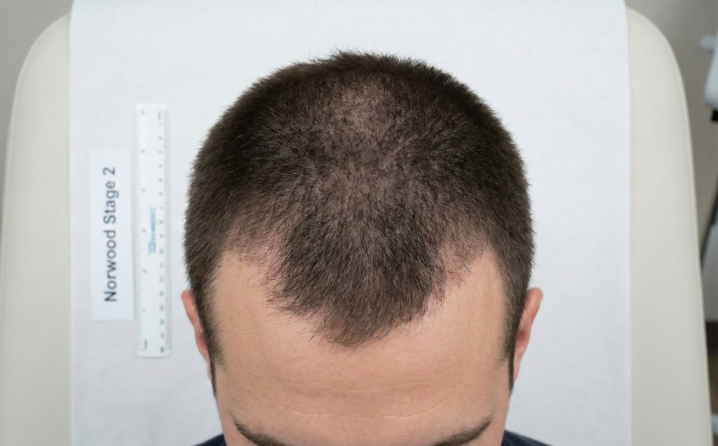 Vue du dessus du cuir chevelu d'un homme présentant une calvitie stade 2 de l'échelle de Norwood-Hamilton — Stade 2 — Récession légère aux tempes
