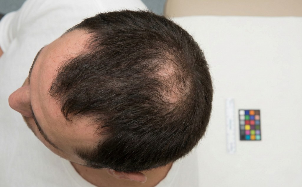 Vue du dessus du cuir chevelu d'un homme présentant une calvitie stade 3V de l'échelle de Norwood-Hamilton — Stade 3 Vertex — Perte au sommet du crâne