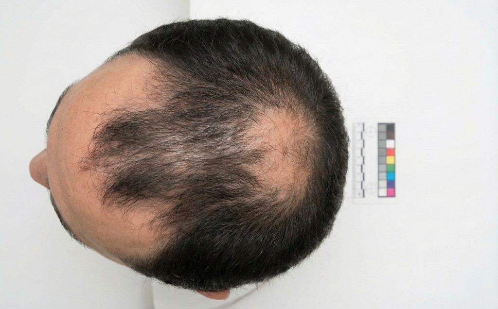 Vue du dessus du cuir chevelu d'un homme présentant une calvitie stade 4 de l'échelle de Norwood-Hamilton — Stade 4 — Calvitie modérée