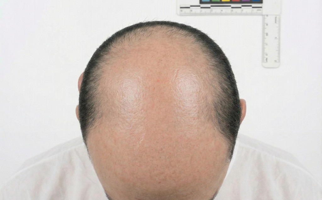 Vue du dessus du cuir chevelu d'un homme présentant une calvitie stade 6 de l'échelle de Norwood-Hamilton — Stade 6 — Calvitie étendue