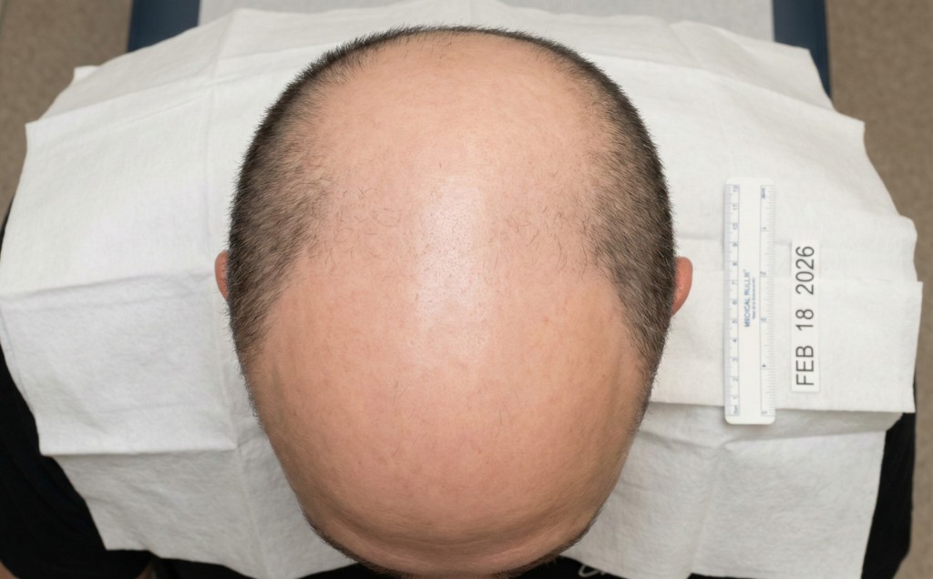 Vue du dessus du cuir chevelu d'un homme présentant une calvitie stade 7 de l'échelle de Norwood-Hamilton — Stade 7 — Calvitie complète