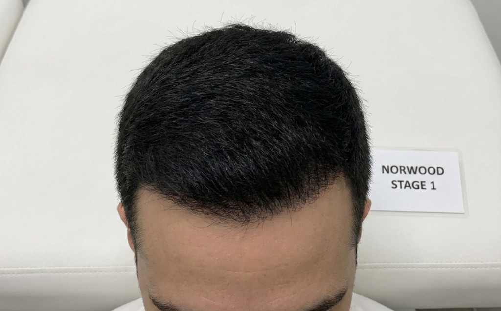 Vue du dessus du cuir chevelu d'un homme présentant une calvitie stade 1 de l'échelle de Norwood-Hamilton — Stade 1 — Pas de perte visible
