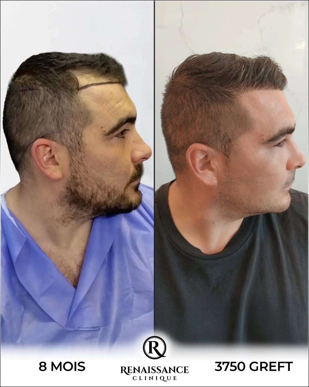 Résultat greffe de cheveux DHI Istanbul - 3750 greffons - 8 mois après - Correction golfes - Patient français - Renaissance Clinique Turquie