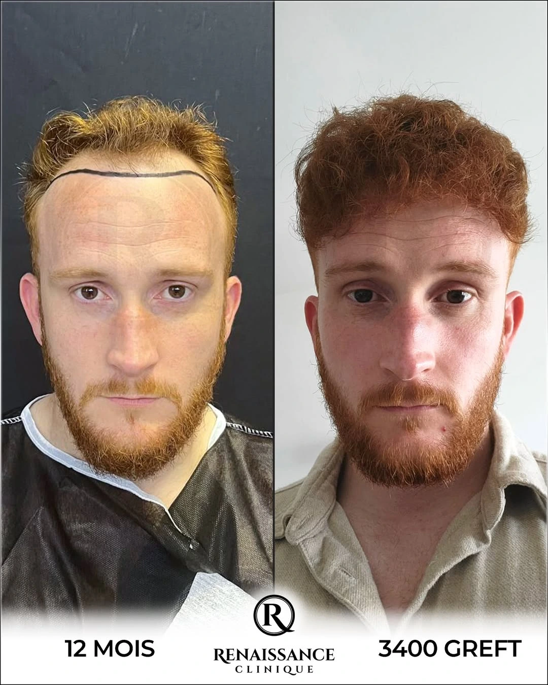 Résultat greffe de cheveux DHI Istanbul - 3400 greffons - 12 mois après - Ligne frontale naturelle - Patient français - Renaissance Clinique Turquie