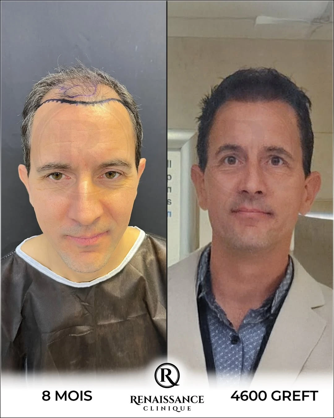Résultat greffe de cheveux FUE Saphir Istanbul - 4600 greffons - 8 mois après - Ligne frontale et golfes - Patient canadien - Renaissance Clinique Turquie