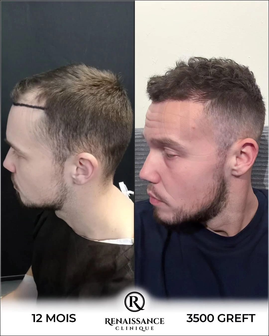 Résultat greffe de cheveux FUE Saphir Istanbul - 3500 greffons - 12 mois après - Patient belge Bruxelles - Renaissance Clinique Turquie