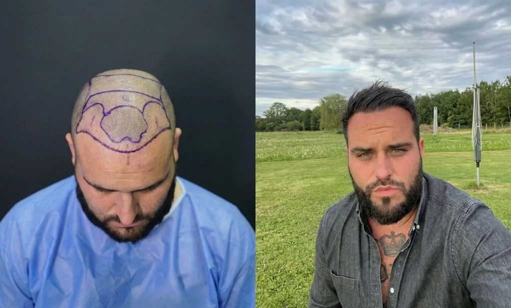 Nikola L. (Les Marseillais) — greffe de cheveux FUE Saphir avant/après : tracé chirurgical des 4500 greffons sur ligne frontale, mid-scalp et vertex (photo pré-opératoire) vs résultat naturel à 9 mois post-opératoire — Renaissance Clinique Istanbul Turquie