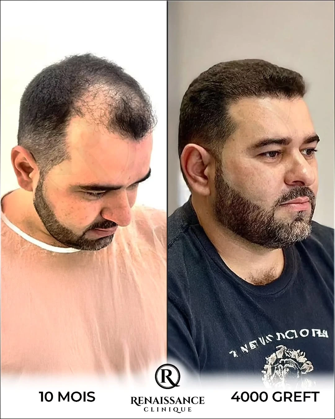 Résultat greffe de cheveux FUE Saphir DHI Istanbul - 4000 greffons - 10 mois après - Densification vertex - Patient belge - Renaissance Clinique Turquie