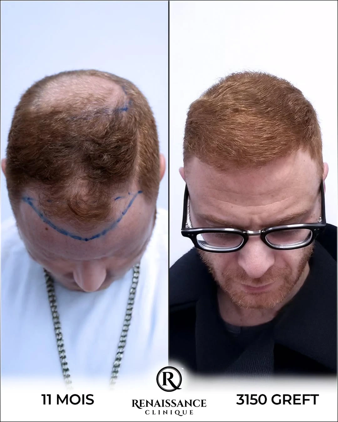 Résultat greffe de cheveux DHI Istanbul - 3150 greffons - 11 mois après - Ligne frontale naturelle - Patient luxembourgeois - Renaissance Clinique Turquie
