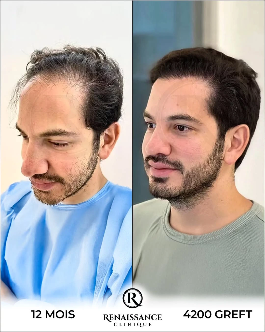 Résultat greffe de cheveux FUE Saphir DHI Istanbul - 4200 greffons - 12 mois après - Patient marocain Casablanca - Renaissance Clinique Turquie