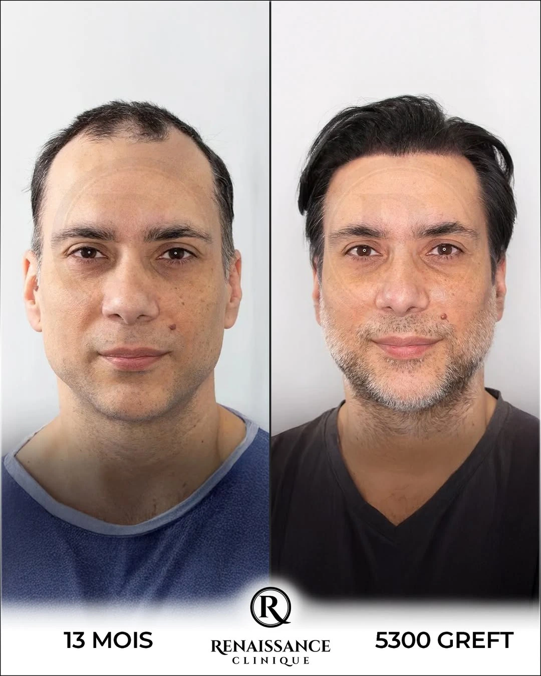 Résultat greffe de cheveux FUE Saphir Istanbul - 5300 greffons - 13 mois après - Reconstruction totale calvitie avancée - Patient suisse - Renaissance Clinique Turquie