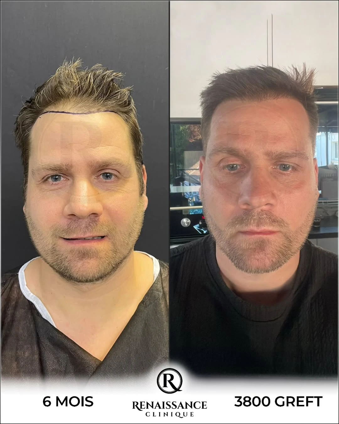 Résultat greffe de cheveux FUE Saphir Istanbul - 3800 greffons - 6 mois après - Cheveux frisés - Patient canadien Montréal - Renaissance Clinique Turquie