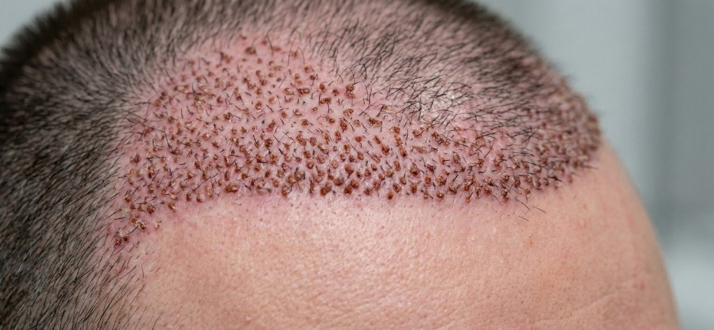 Cicatrisation post-greffe capillaire à J5 : vue rapprochée de la zone receveuse avec micro-croûtes en formation autour de chaque greffon implanté, rougeurs rosées légères sur le cuir chevelu, cheveux natifs environnants visibles