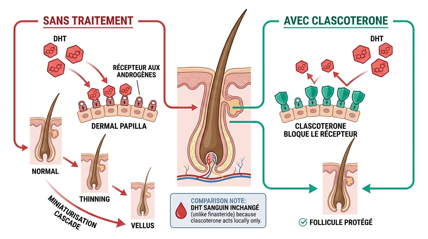 Diagramme médical du mécanisme d'action du clascotérone : à gauche (SANS TRAITEMENT), la DHT circulante se lie aux récepteurs androgènes du follicule pileux, activant la cascade de miniaturisation en 4 stades ; à droite (AVEC CLASCOTÉRONE), la molécule de clascotérone occupe les récepteurs androgènes au niveau du follicule, empêchant la DHT de s'y fixer — le taux de DHT sanguine reste intact, aucun effet hormonal systémique