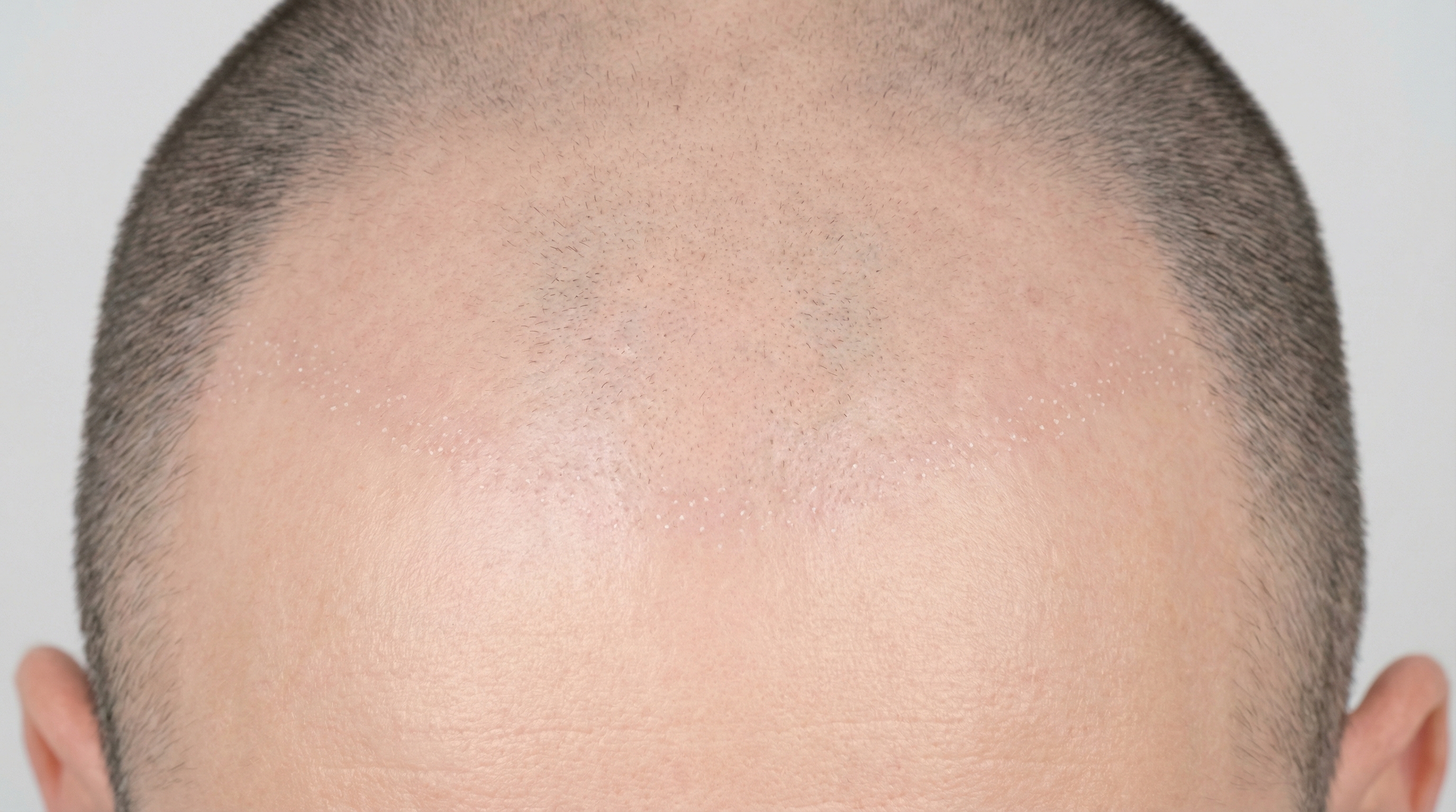 Photo clinique du cuir chevelu 2 mois après greffe de cheveux FUE : vue du dessus montrant la zone greffée entièrement cicatrisée, shock loss terminé, aucune repousse visible, peau lisse sans rougeurs ni croûtes