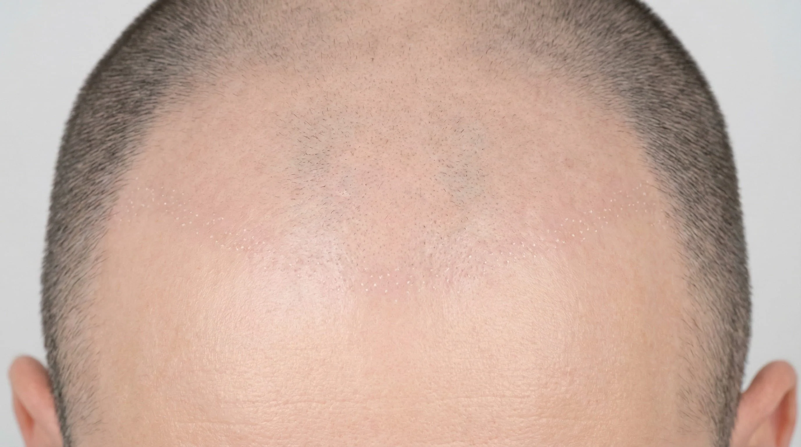 Photo Greffe de Cheveux à 2 Mois — Cuir Chevelu Cicatrisé Post-Shock Loss | Renaissance Clinique Photo clinique du cuir chevelu 2 mois après greffe de cheveux FUE : vue du dessus montrant la zone greffée entièrement cicatrisée, shock loss terminé, aucune repousse visible, peau lisse sans rougeurs ni croûtes