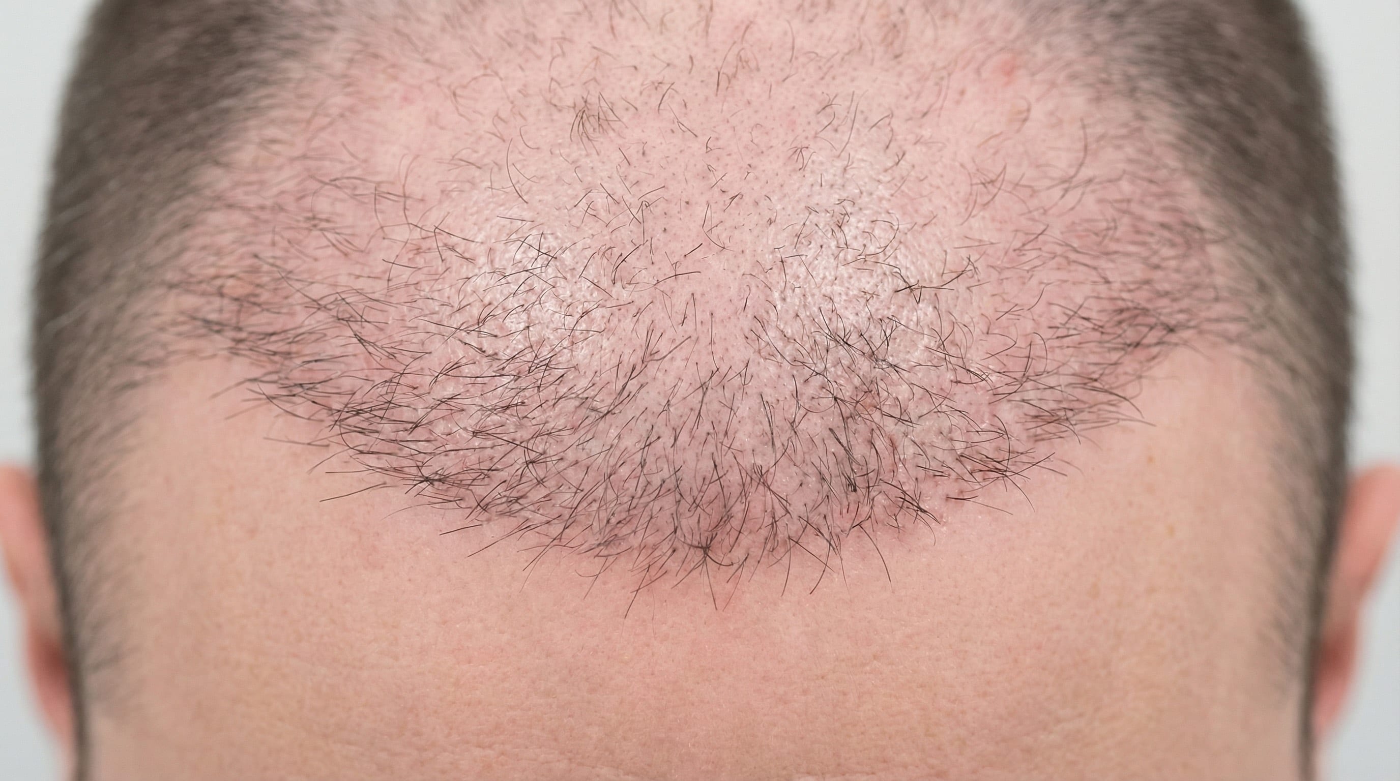 Résultat de greffe de cheveux à 6 mois : vue du dessus montrant la repousse active sur la ligne frontale avec 40-60 % de densité visible, cheveux fins en épaississement progressif