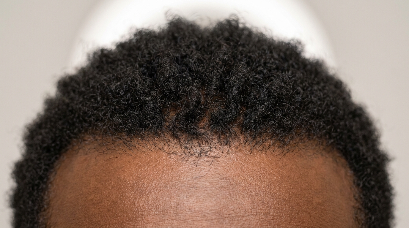 Greffe de cheveux sur peau noire : résultat naturel par FUE Saphir avec punches adaptés aux cheveux afro-texturés | Renaissance Clinique Patient à peau noire après greffe capillaire FUE Saphir à Istanbul : résultat naturel et dense sur cheveux crépus, ligne frontale restaurée, aucune cicatrice chéloïde visible — technique d'extraction adaptée aux follicules courbes avec punches 0,8 mm