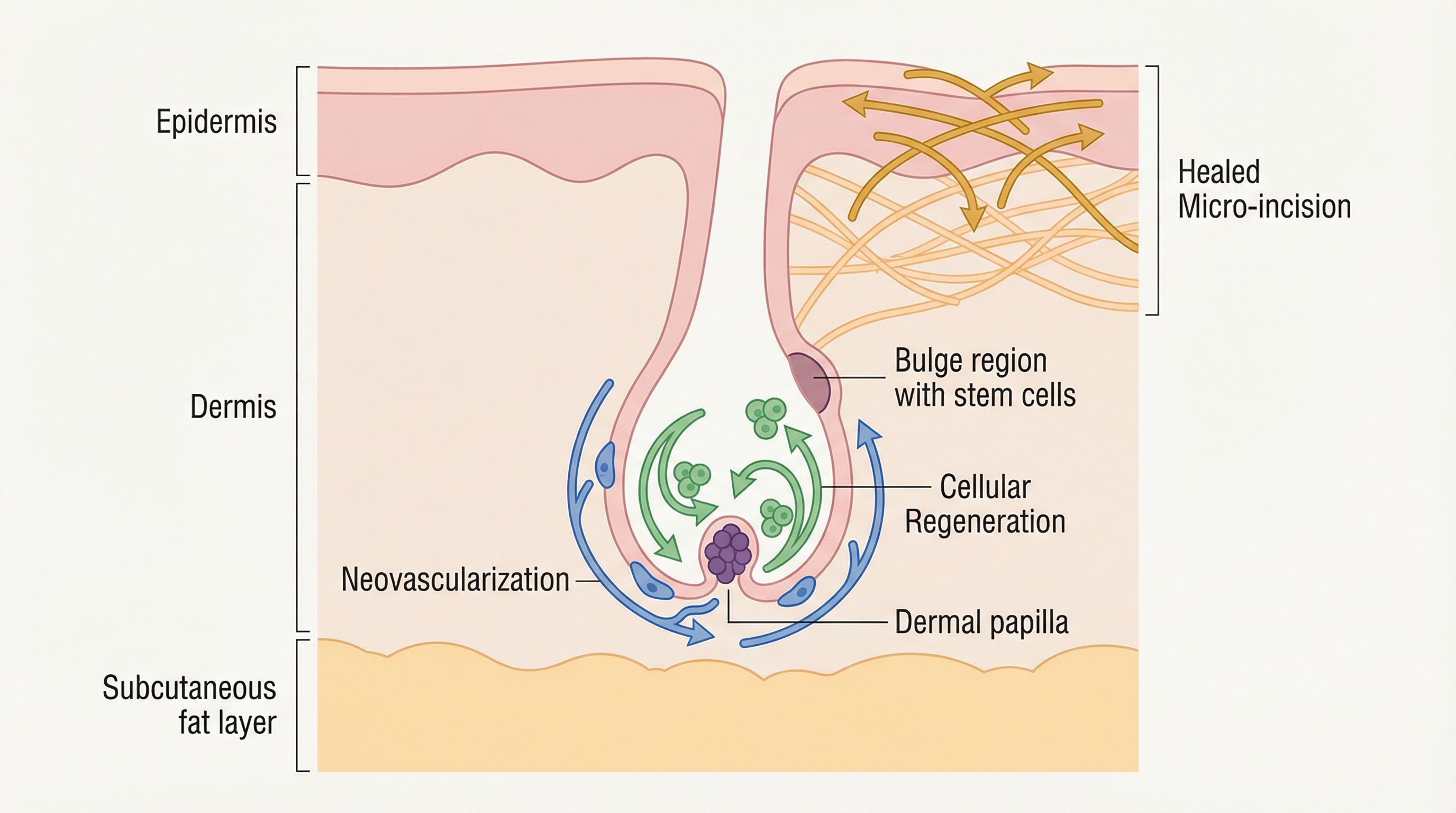 Schéma médical du follicule capillaire à 2 mois post-greffe : phase télogène avec bulbe vivant, néovascularisation, régénération cellulaire et stabilisation du collagène sous la peau