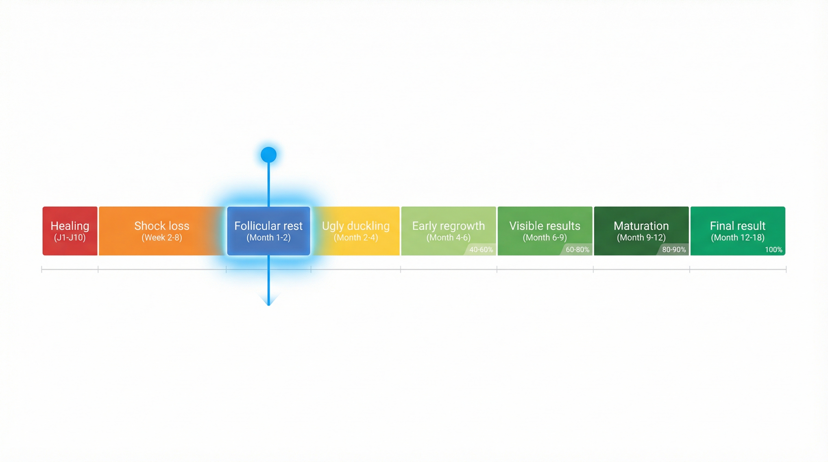 Timeline de la repousse post-greffe de cheveux avec position actuelle à 2 mois : 8 phases du jour 1 au mois 18, repos folliculaire mis en évidence avec marqueur bleu « Vous êtes ici »