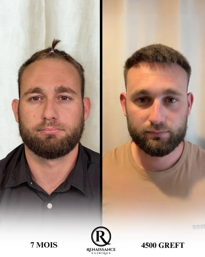 Greffe de cheveux homme — résultat réel de face, 4 500 greffons à 7 mois (avant / après)