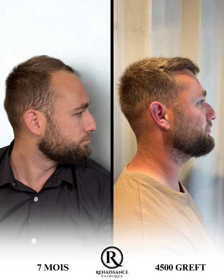 Greffe de cheveux homme — résultat réel de profil, 4 500 greffons à 7 mois (avant / après)