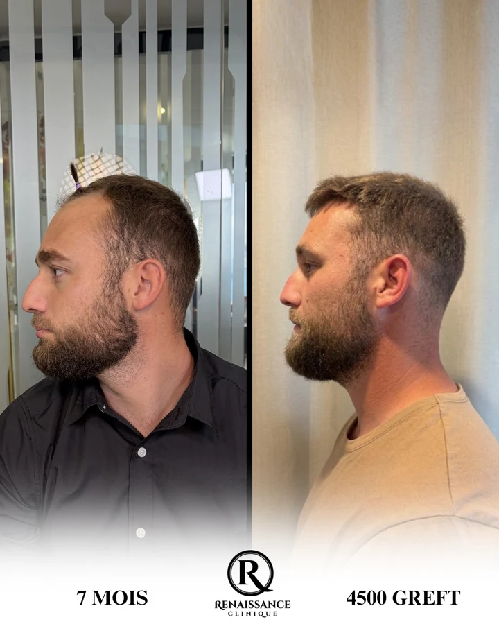 Greffe de cheveux homme — résultat réel de profil, 4 500 greffons à 7 mois (avant / après)