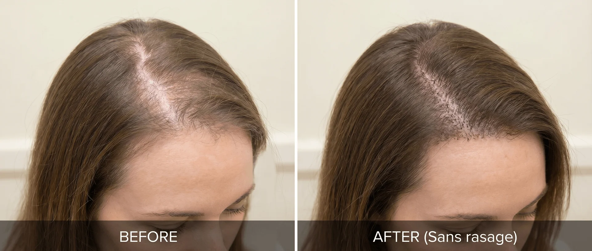 Avant/après greffe Choi Pen sans rasage chez une femme : à gauche (Before), alopécie visible le long de la raie et de la ligne frontale avec cheveux mi-longs châtains clairsemés ; à droite (After, Unshaven Choi Pen), greffons implantés entre les cheveux existants par technique Choi Pen sans rasage, densification nette de la raie et de la zone frontale, aucun rasage visible, cheveux existants couvrant la zone d’intervention