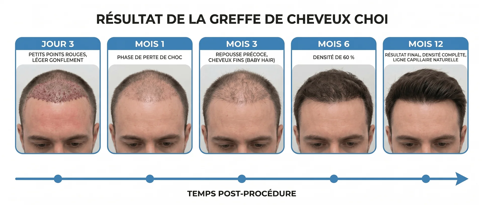Chronologie des résultats d’une greffe de cheveux Choi Pen en 5 étapes sur un patient masculin : Jour 3 (petits points rouges, léger gonflement frontal), Mois 1 (phase de perte de choc, chute temporaire des cheveux implantés), Mois 3 (repousse précoce, cheveux fins baby hair), Mois 6 (densité de 60%, épaississement progressif), Mois 12 (résultat final, densité complète, ligne capillaire naturelle). Flèche chronologique indiquant le temps post-procédure