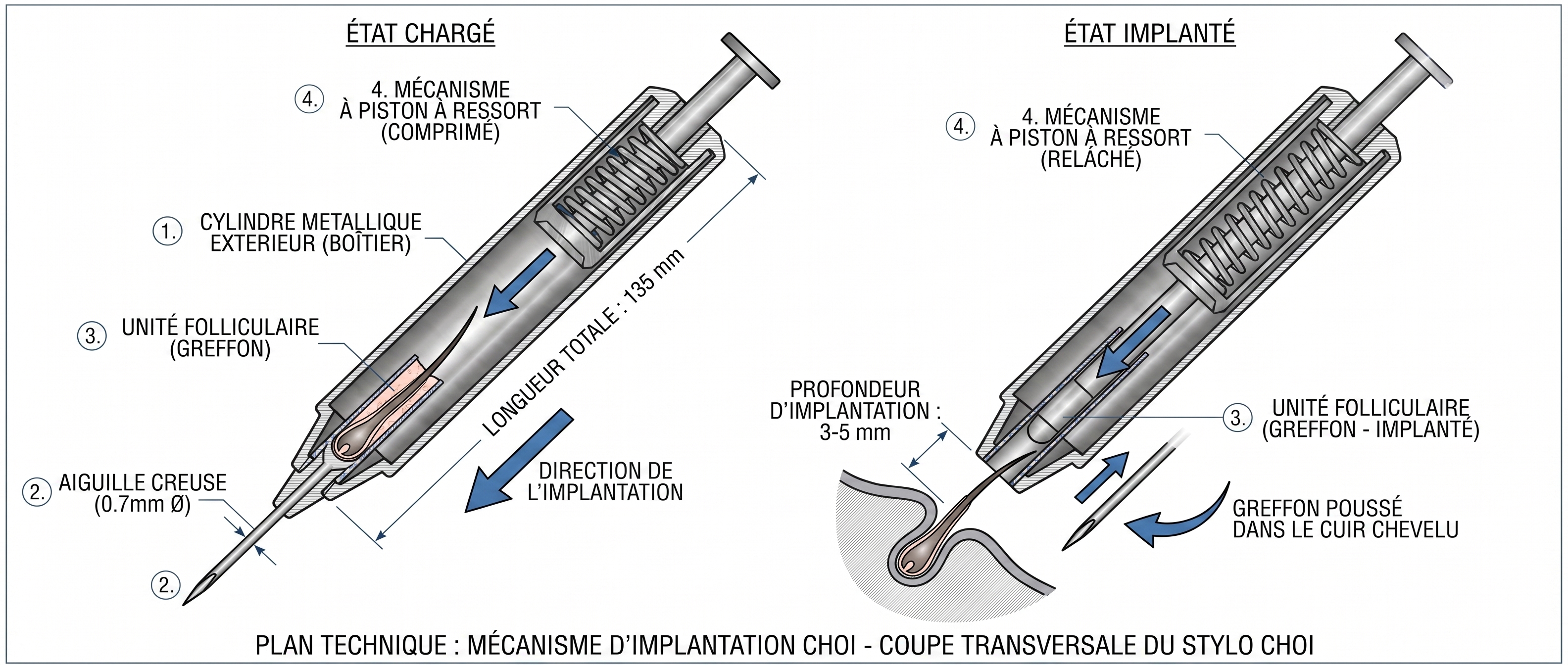 Plan technique en coupe transversale du stylo implanteur Choi pour greffe Choi Pen : état chargé (gauche) montrant le cylindre métallique extérieur, l’aiguille creuse de 0.7mm, l’unité folliculaire (greffon) dans le canal et le mécanisme à piston à ressort compressé — état implanté (droite) montrant le piston relâché poussant le greffon dans le cuir chevelu à une profondeur de 3-5mm, longueur totale du stylo 135mm