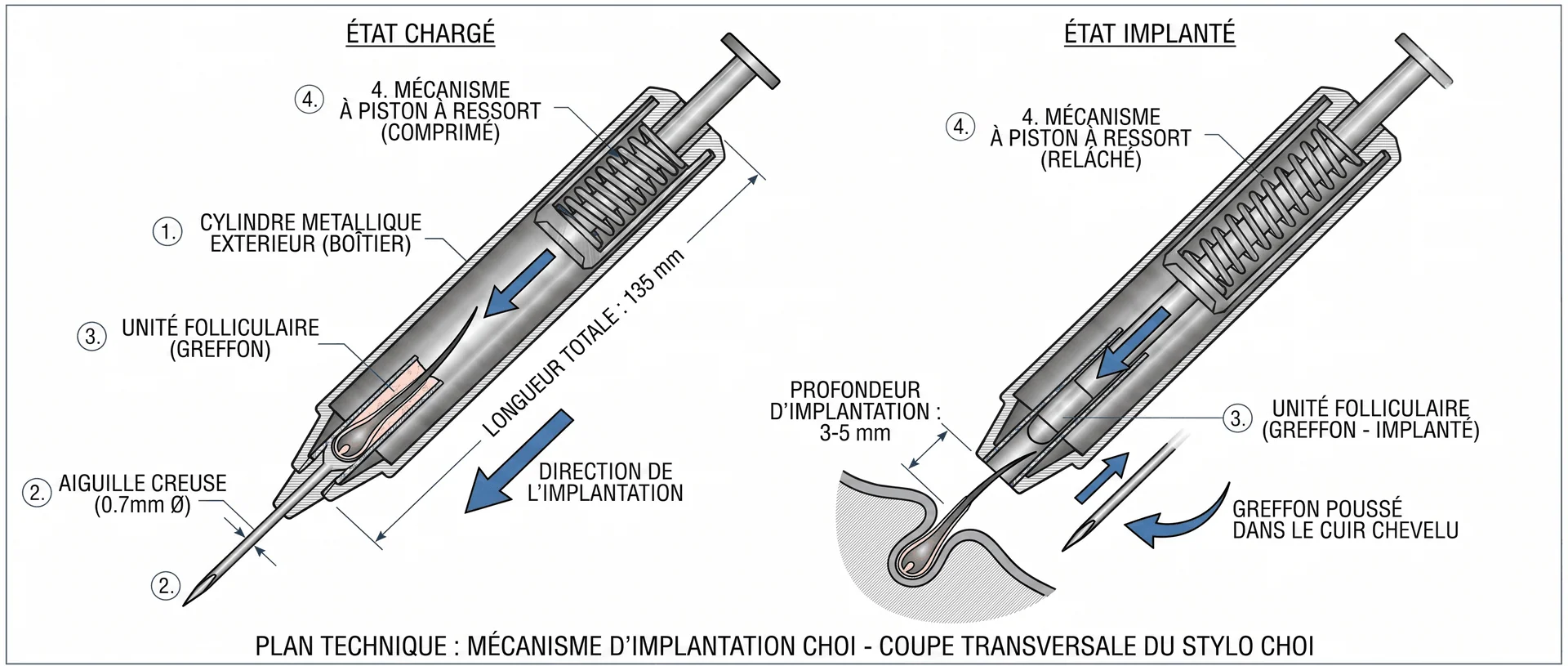 Plan technique en coupe transversale du stylo implanteur Choi pour greffe Choi Pen : état chargé (gauche) montrant le cylindre métallique extérieur, l’aiguille creuse de 0.7mm, l’unité folliculaire (greffon) dans le canal et le mécanisme à piston à ressort compressé — état implanté (droite) montrant le piston relâché poussant le greffon dans le cuir chevelu à une profondeur de 3-5mm, longueur totale du stylo 135mm