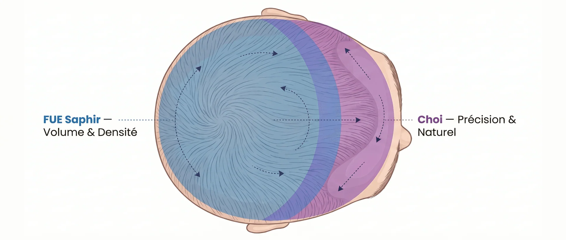 Cartographie des Zones de Traitement Hybride FUE Saphir + Choi Pen — Vue de Dessus du Cuir Chevelu | Renaissance Clinique Schéma vue de dessus (bird's eye) du cuir chevelu masculin montrant les zones de traitement de l'approche hybride greffe capillaire : zone postérieure (vertex, mid-scalp, couronne) en bleu pour la FUE Saphir — Volume & Densité, zone antérieure (ligne frontale, tempes) en violet pour la Choi Pen — Précision & Naturel, avec une zone de transition bleu-violet au mid-scalp et les directions naturelles de pousse des cheveux indiquées par des flèches