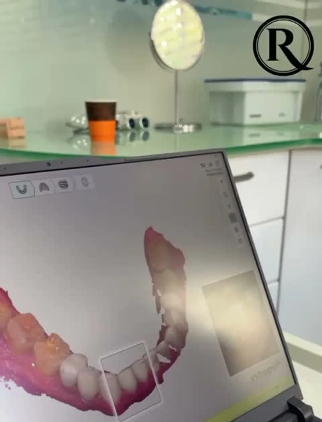 Scan 3D intra-oral du sourire de Nikola Lozina affiché à l'écran lors de l'empreinte numérique à Renaissance Clinique