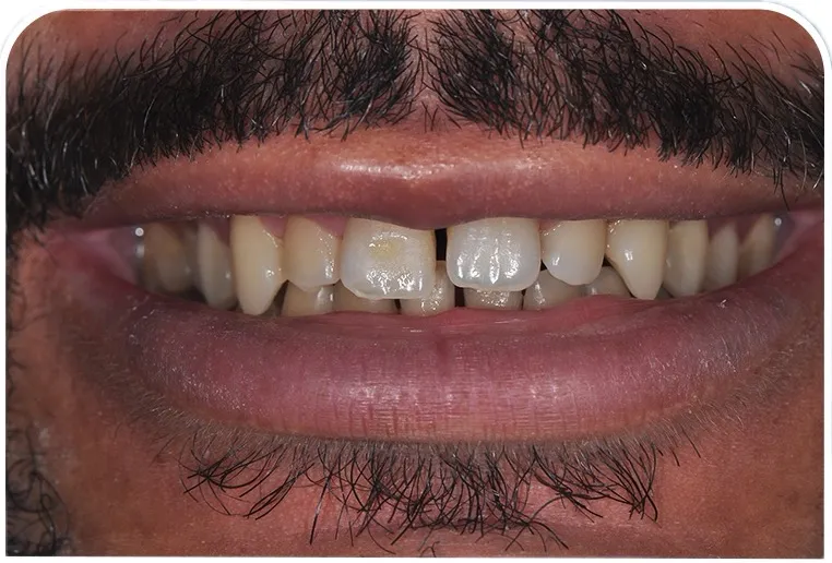 Sourire de Nico Là avant facettes — dents naturelles, teintes inégales et légers désalignements