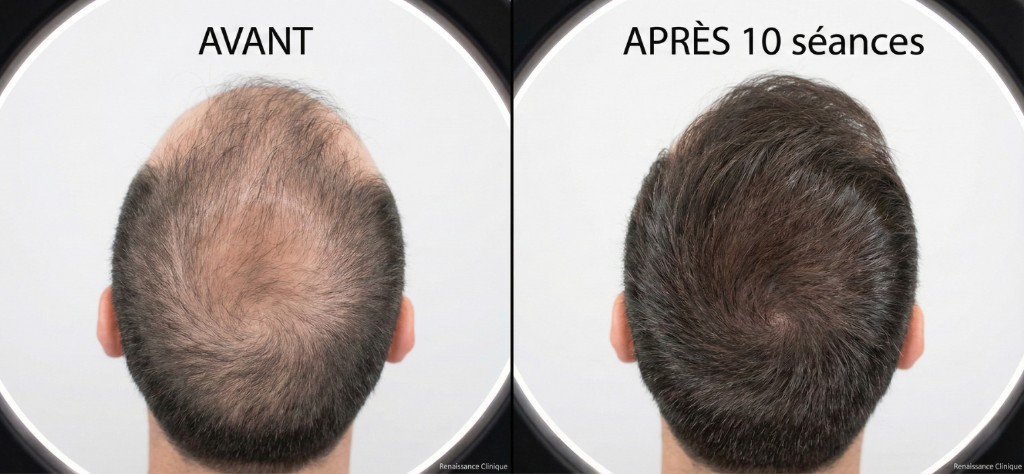 Résultat avant/après mésothérapie capillaire sur le vertex (sommet du crâne) d'un patient masculin : à gauche (AVANT) — vue plongeante montrant un amincissement capillaire diffus avec cuir chevelu largement visible à travers des cheveux clairsemés, fins et sans volume ; à droite (APRÈS 10 séances) — même angle et même patient montrant une densité capillaire nettement améliorée, cheveux plus épais et plus denses, cuir chevelu beaucoup moins visible, volume et couverture restaurés. Photos prises sous éclairage clinique identique (ring light), fond noir, watermark Renaissance Clinique