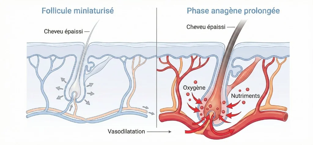 Mécanisme d'action du minoxidil : vasodilatation périfolliculaire et prolongation de la phase anagène — Minoxidil Cheveux | Renaissance Clinique Schéma médical du mécanisme d'action du minoxidil sur le follicule pileux : à gauche, follicule miniaturisé avec cheveu épaissi et vaisseaux sanguins réduits — à droite, phase anagène prolongée après traitement au minoxidil avec vasodilatation, apport accru en oxygène et nutriments, et cheveu épaissi en croissance active