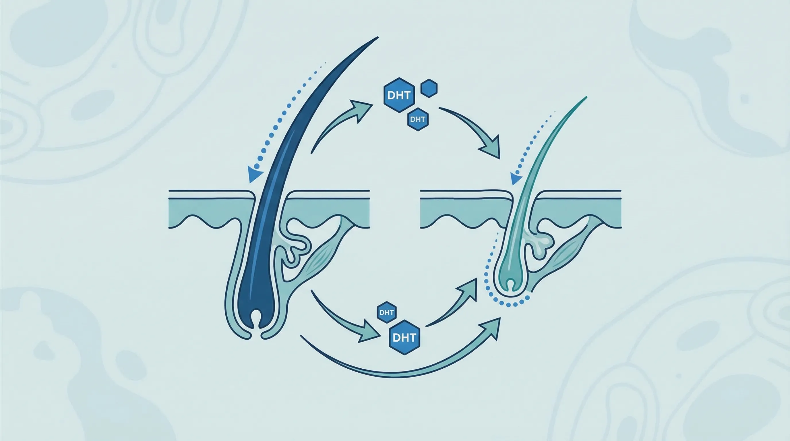 Schéma du mécanisme de la DHT dans l'alopécie masculine : conversion testostérone en DHT, fixation sur les récepteurs androgéniques et miniaturisation progressive du follicule pileux