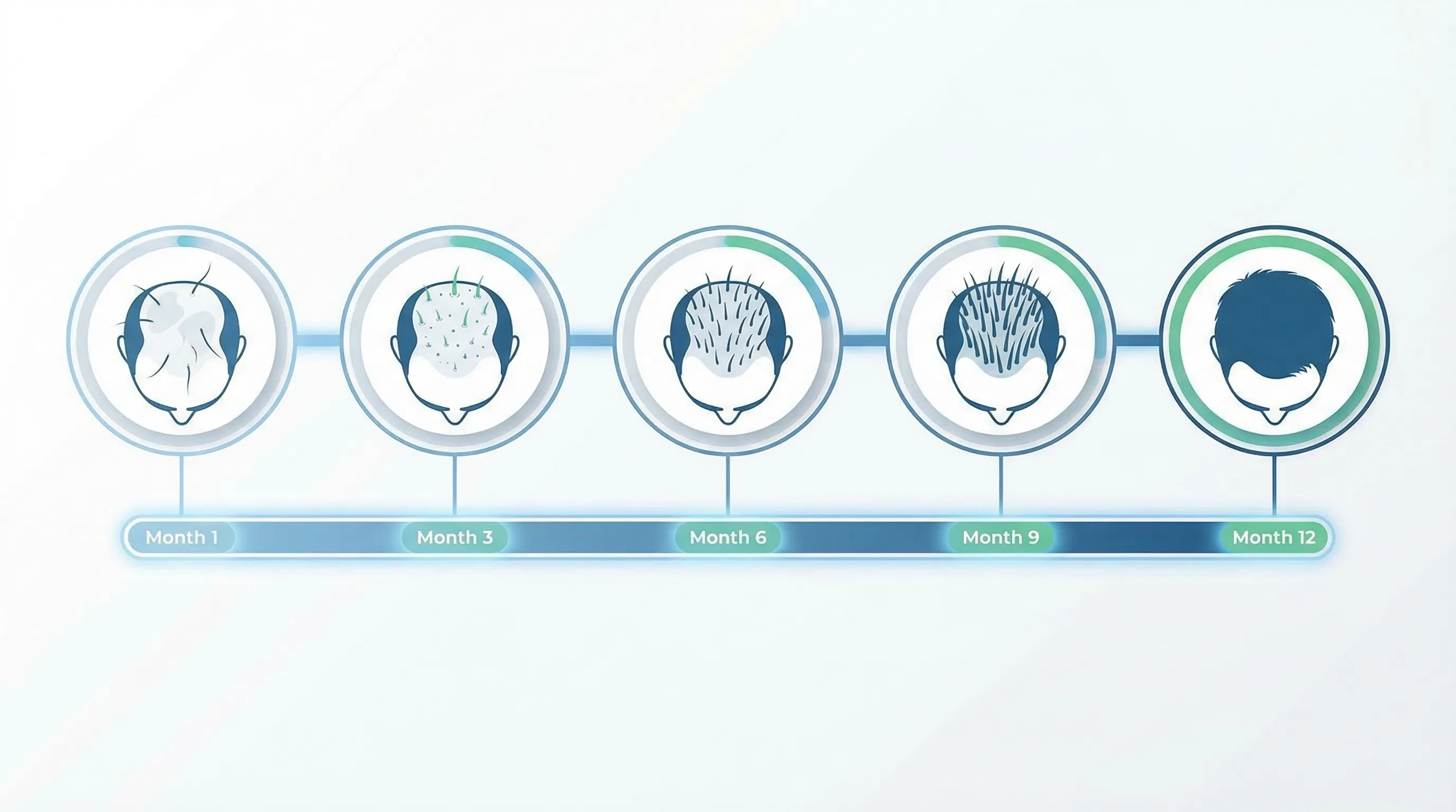 Timeline de repousse capillaire après greffe de cheveux : évolution mois par mois du jour 1 au mois 18, montrant le shock loss, la phase de dormance, la repousse progressive et le résultat final