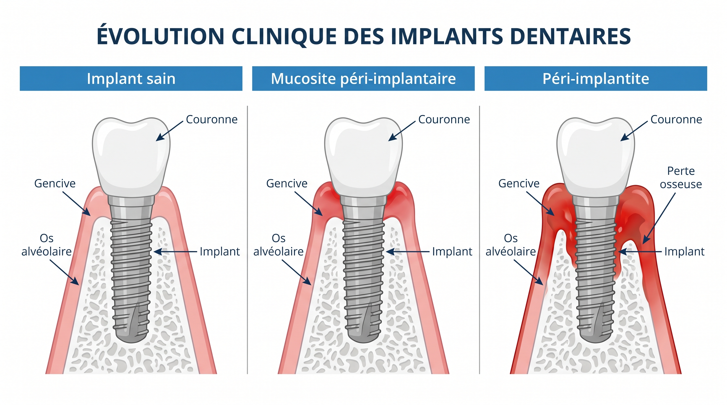 Diagramme médical éducatif vue en coupe sagittale comparant trois états d'implants dentaires en français : à gauche implant sain avec os alvéolaire intact et gencive rose saine étiquetée 'Implant sain', au centre mucosite péri-implantaire avec gencive rouge inflammée mais os préservé étiquetée 'Mucosite péri-implantaire', à droite péri-implantite avec perte osseuse verticale visible et gencive très enflammée étiquetée 'Péri-implantite' — style textbook médical professionnel avec flèches indicatrices